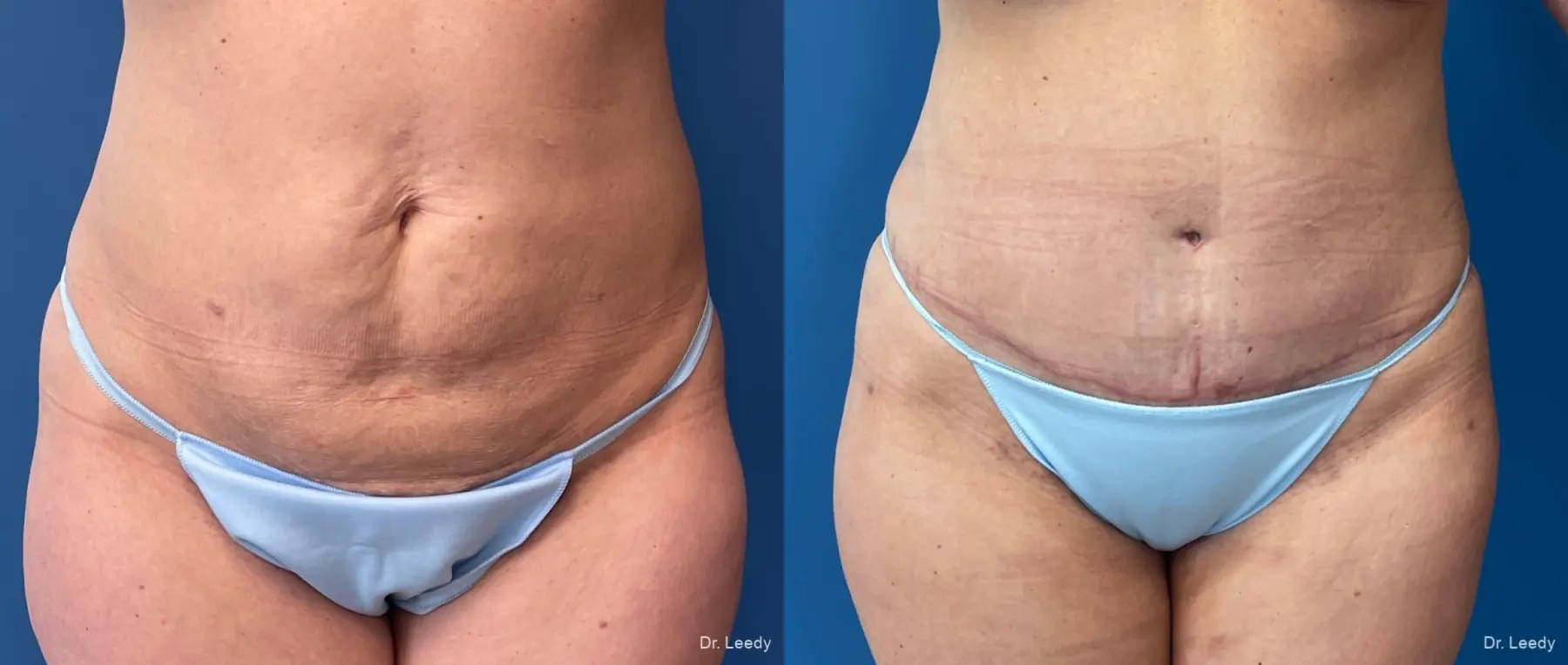 Abdominoplasty: Patient 15 - Before and After  