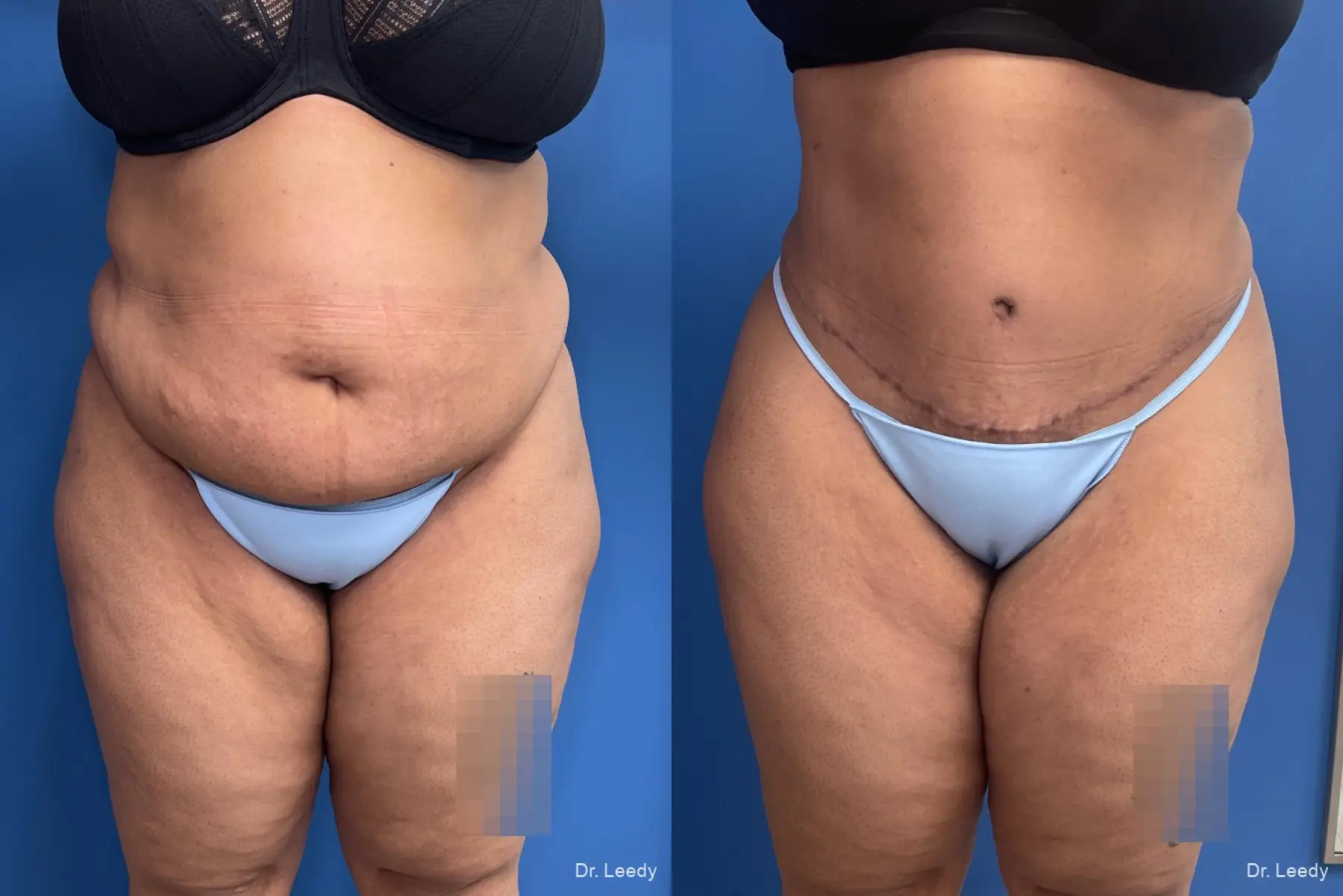 Abdominoplasty: Patient 18 - Before and After  