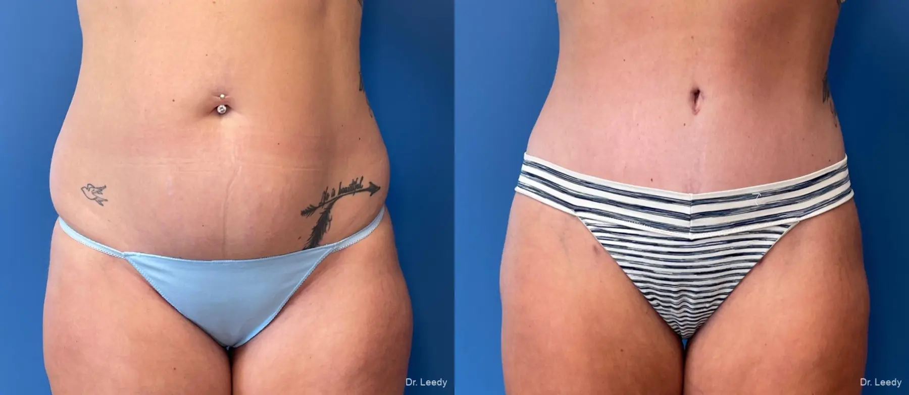 Abdominoplasty: Patient 12 - Before and After  