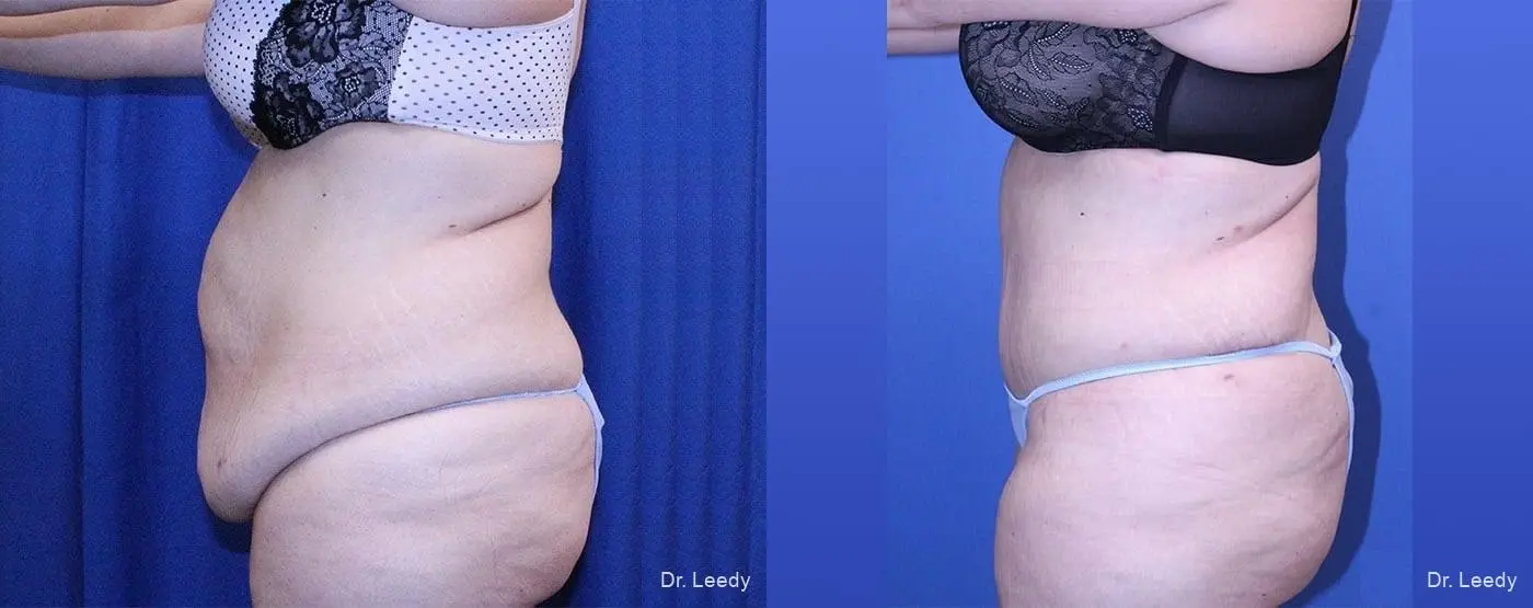 Abdominoplasty: Patient 11 - Before and After 5