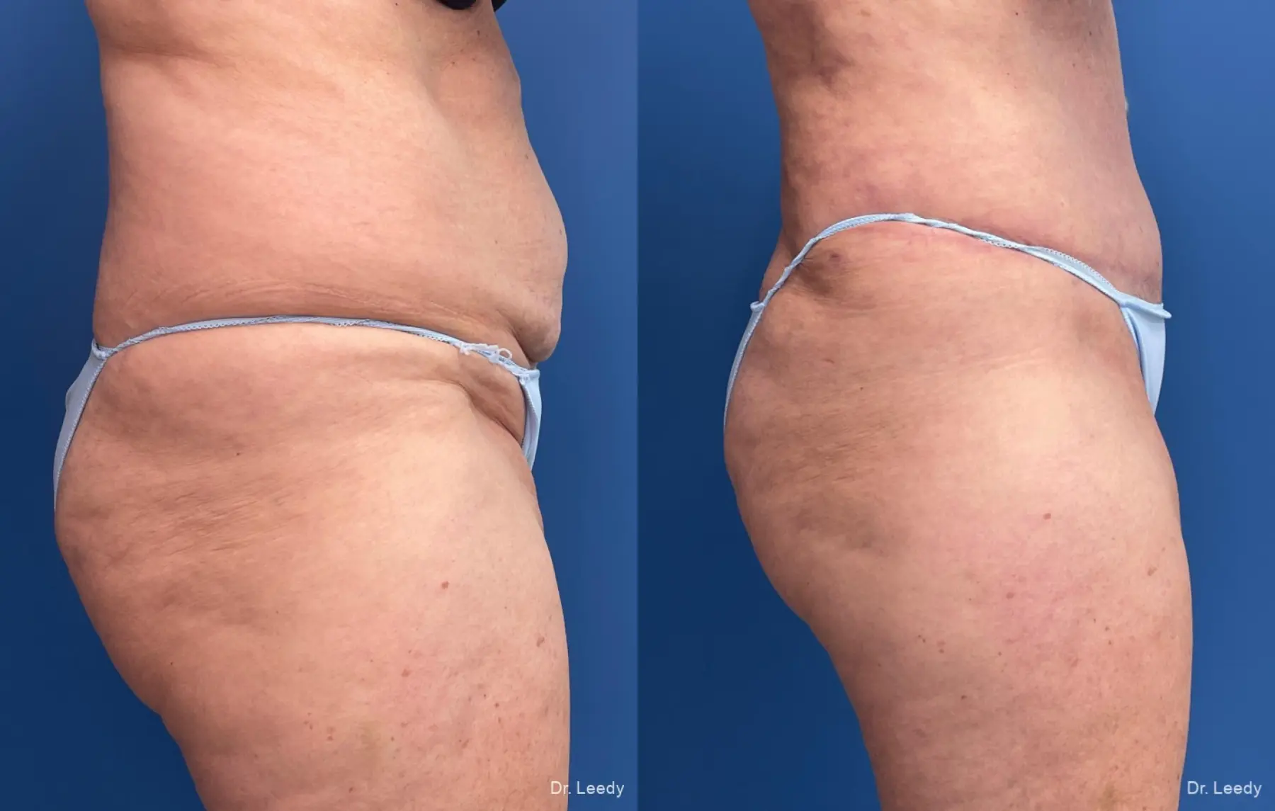 Abdominoplasty: Patient 22 - Before and After 3