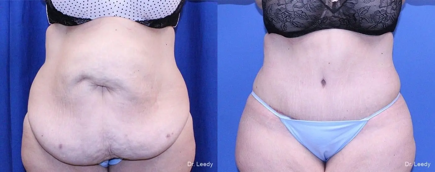 Abdominoplasty: Patient 38 - Before and After  