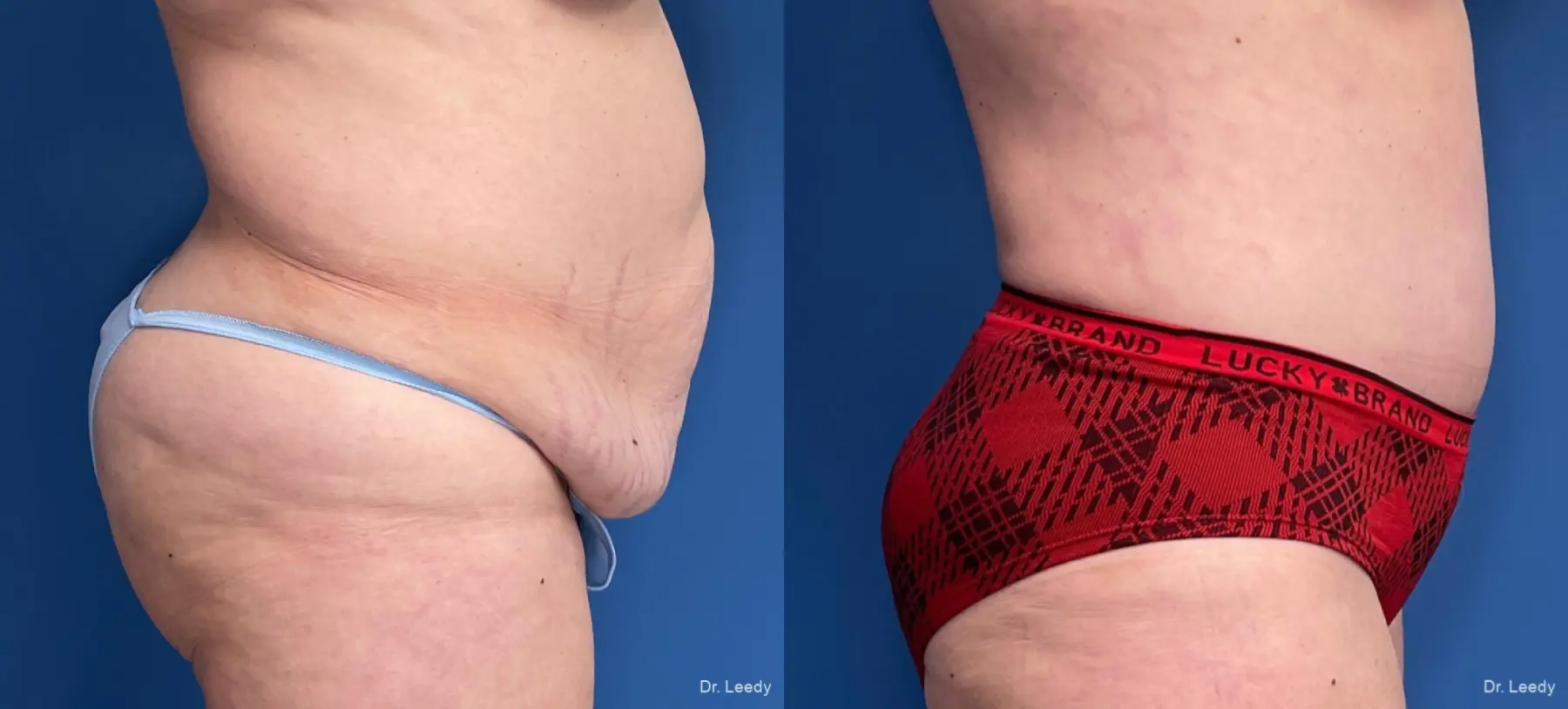 Abdominoplasty: Patient 24 - Before and After 3