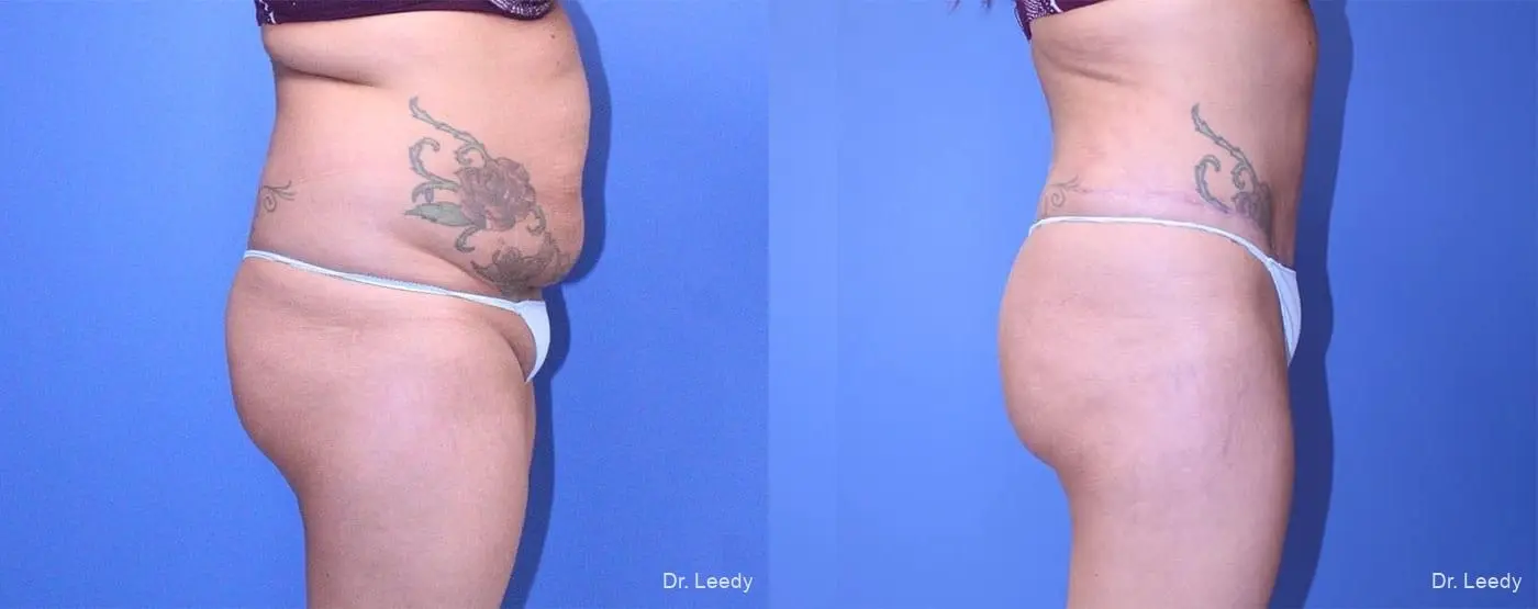 Abdominoplasty: Patient 6 - Before and After 4