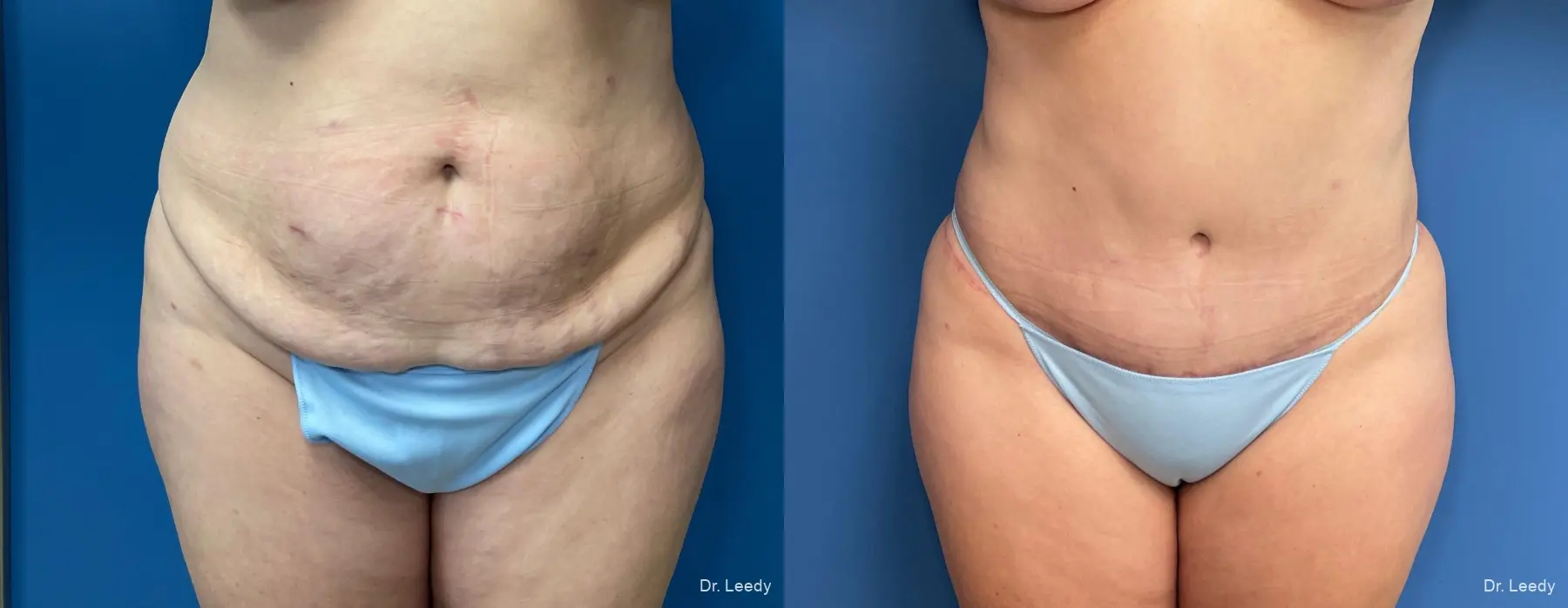 Abdominoplasty: Patient 11 - Before and After  
