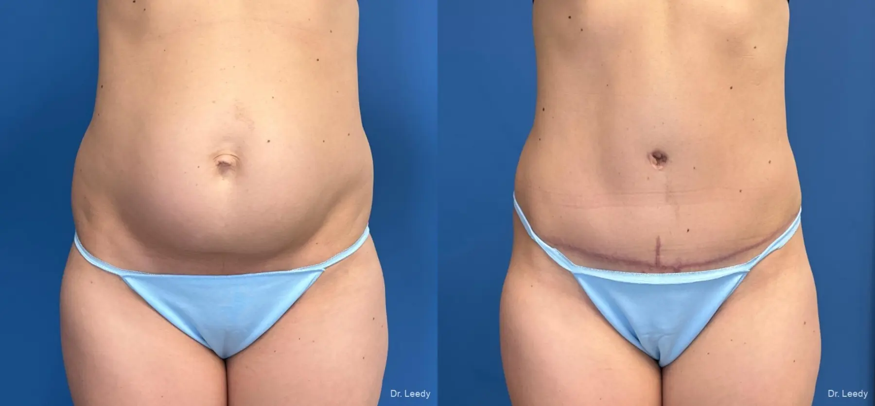 Abdominoplasty: Patient 42 - Before and After  