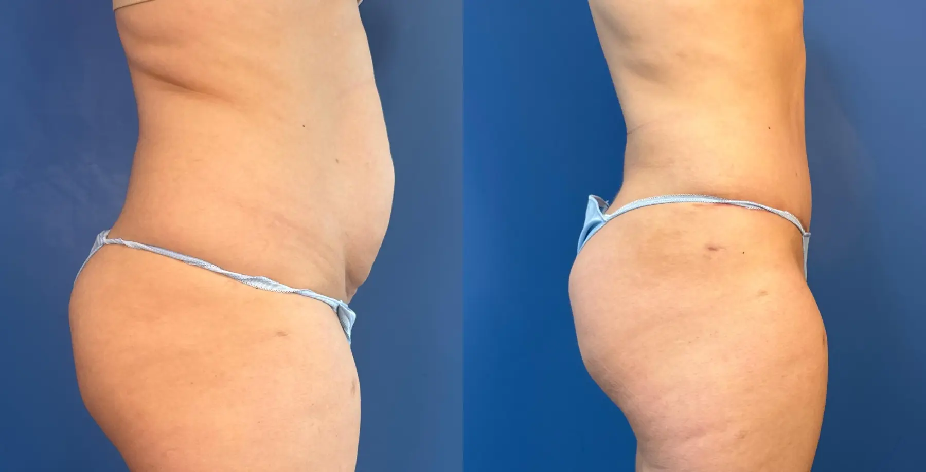 Abdominoplasty: Patient 51 - Before and After 3
