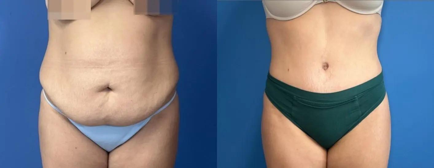 Abdominoplasty: Patient 28 - Before and After  