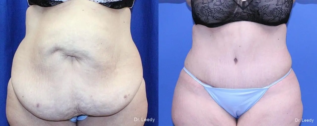 Abdominoplasty: Patient 4 - Before and After  