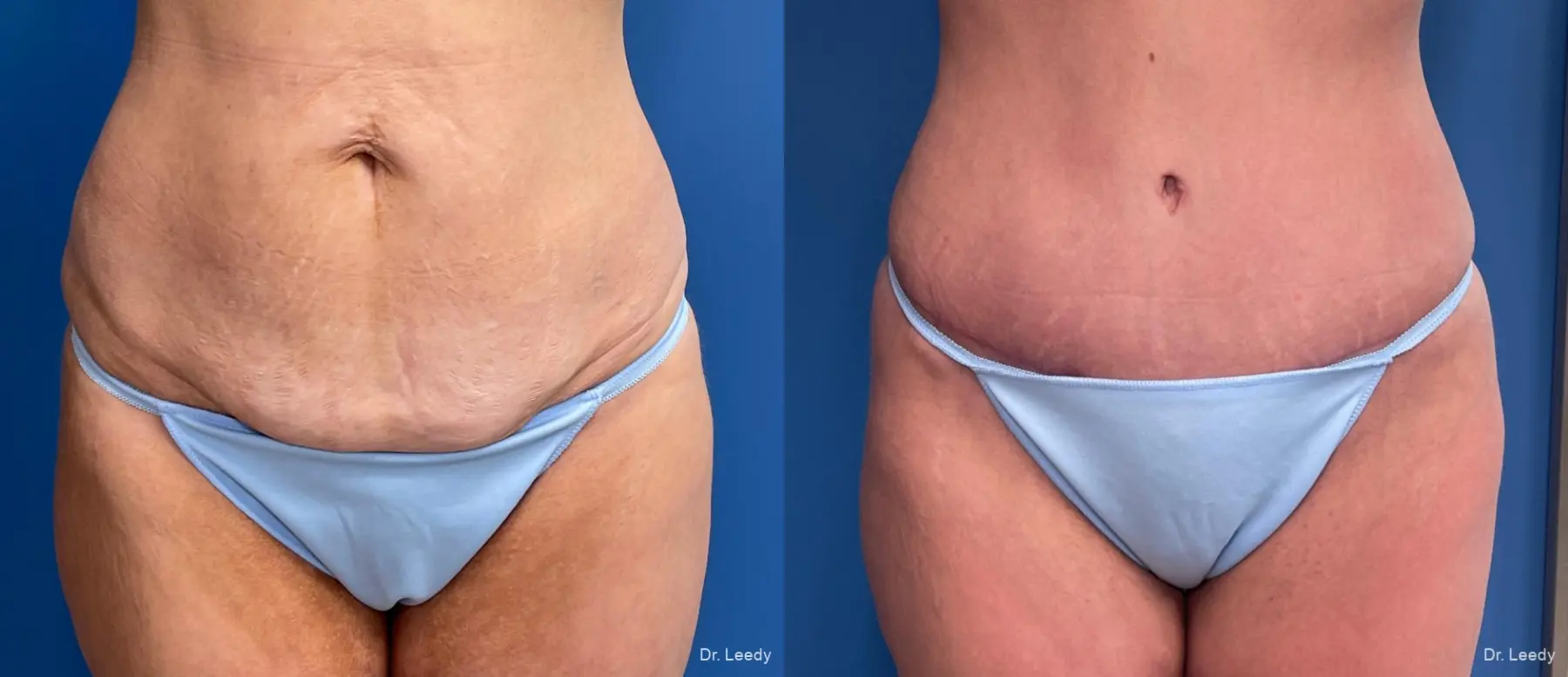 Abdominoplasty: Patient 14 - Before and After  