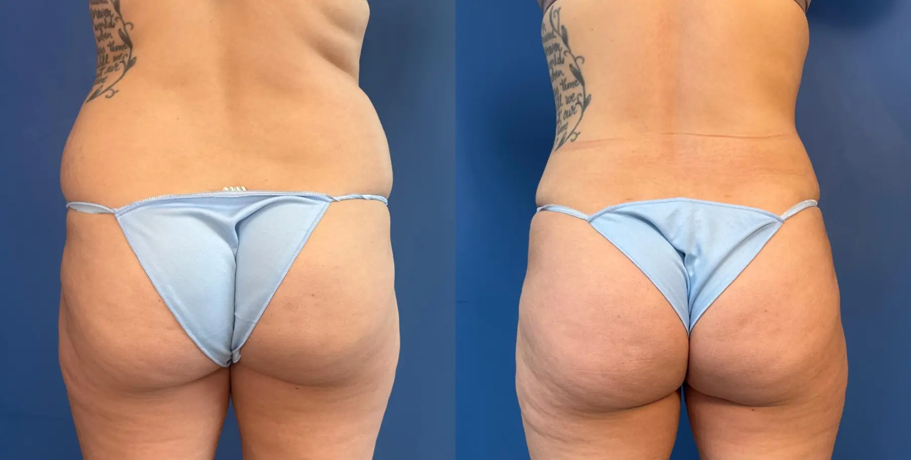 Abdominoplasty: Patient 51 - Before and After 4