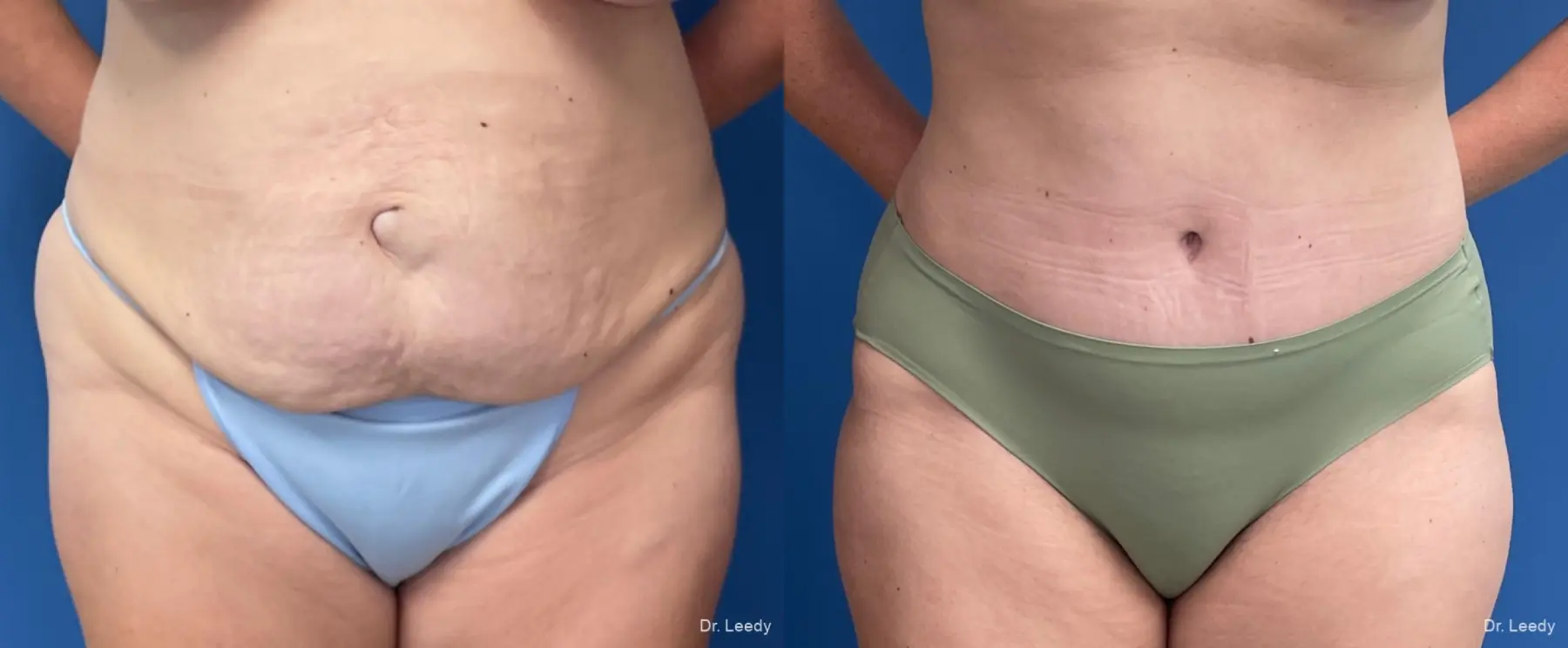 Abdominoplasty: Patient 23 - Before and After 1