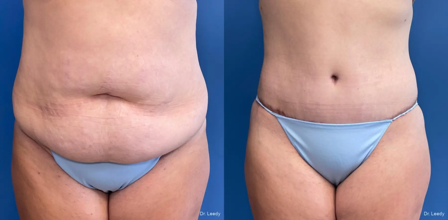 Abdominoplasty: Patient 1 - Before and After  