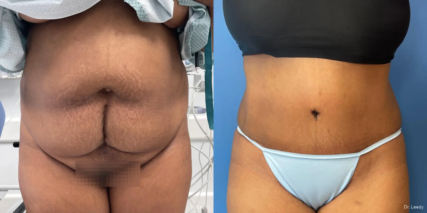 Abdominoplasty: Patient 20 - Before and After  