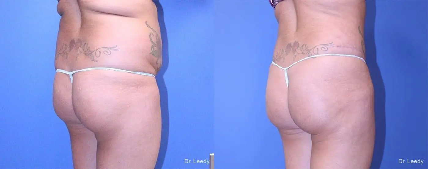 Abdominoplasty: Patient 6 - Before and After 3