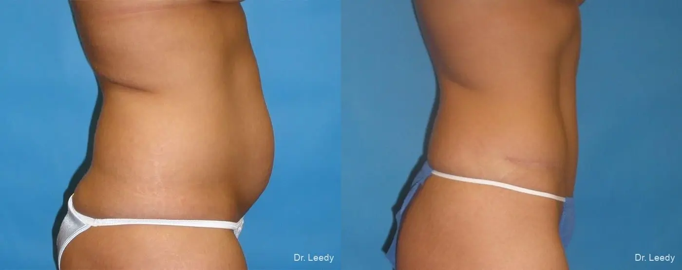 Abdominoplasty: Patient 10 - Before and After 3