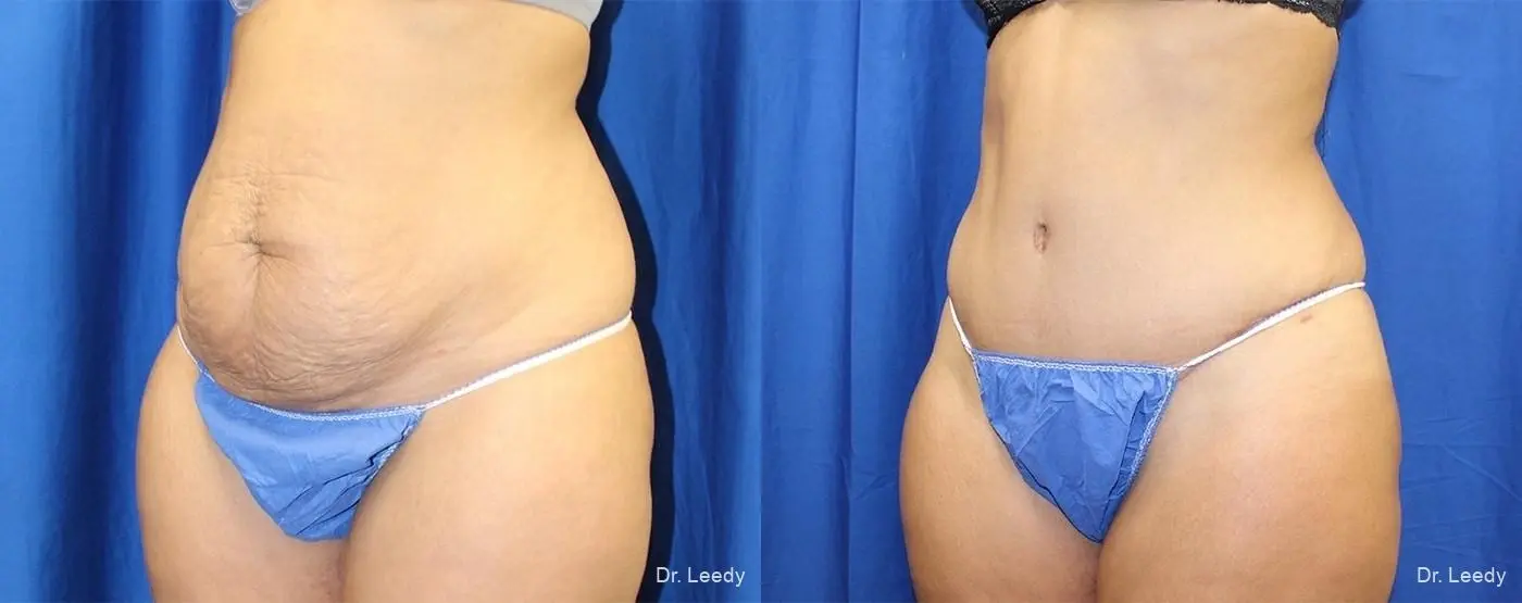 Abdominoplasty: Patient 9 - Before and After 4