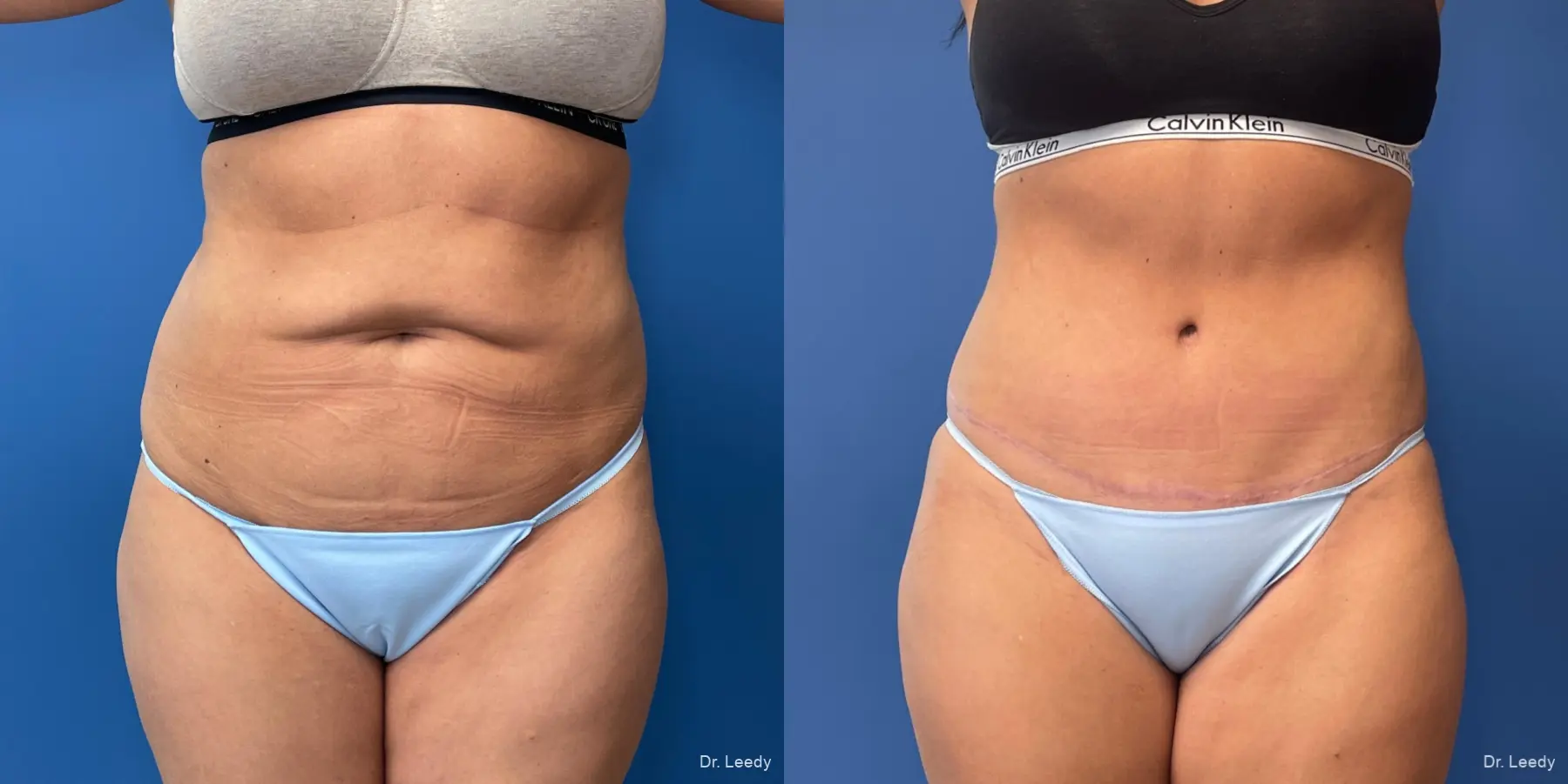 Abdominoplasty: Patient 5 - Before and After  