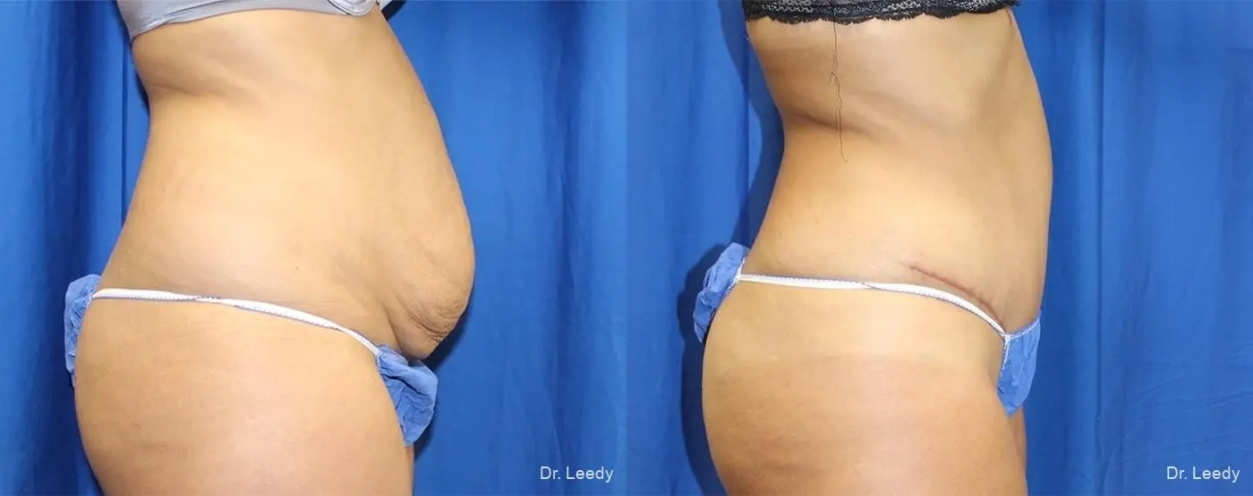 Abdominoplasty: Patient 9 - Before and After 3
