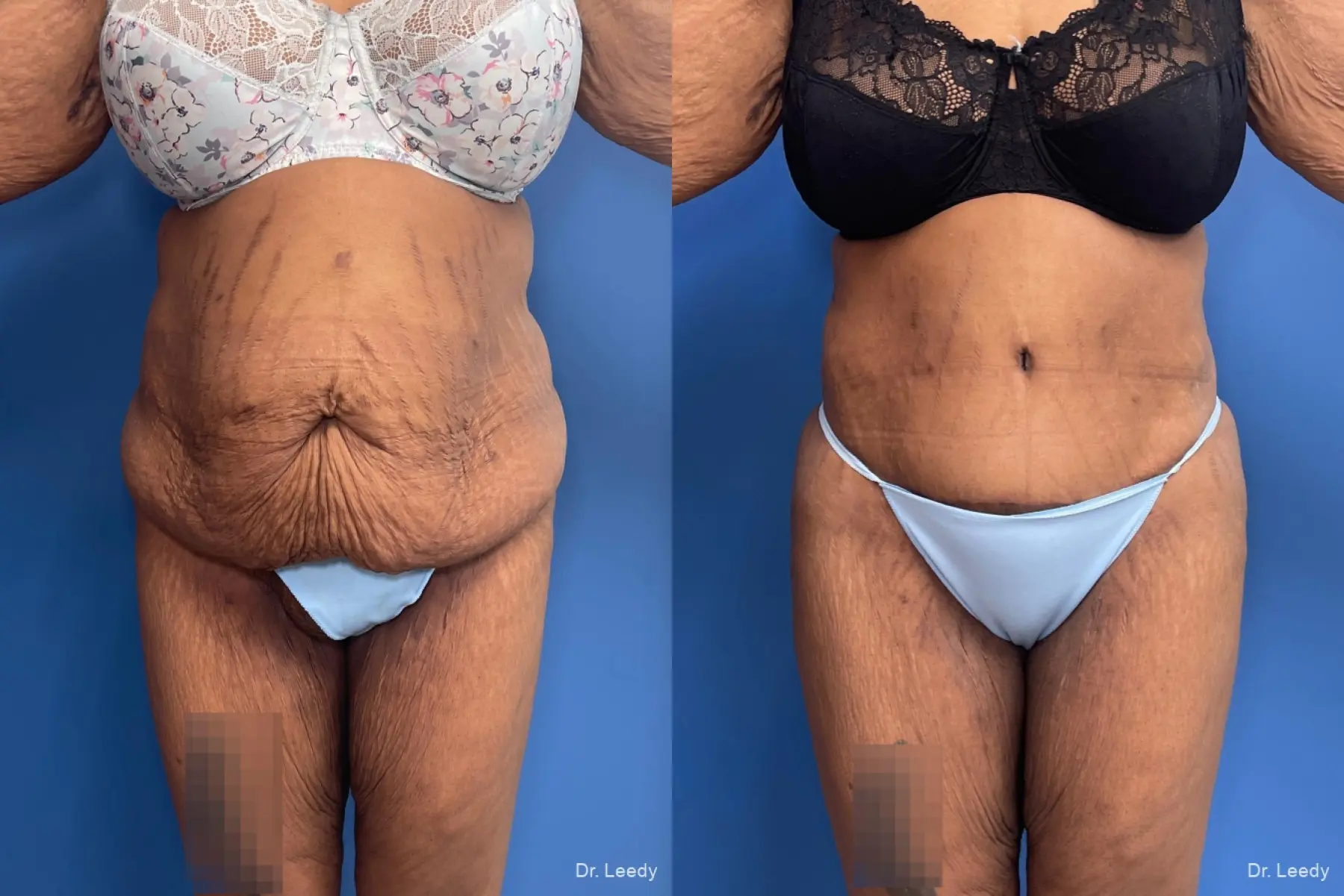 Abdominoplasty: Patient 16 - Before and After  