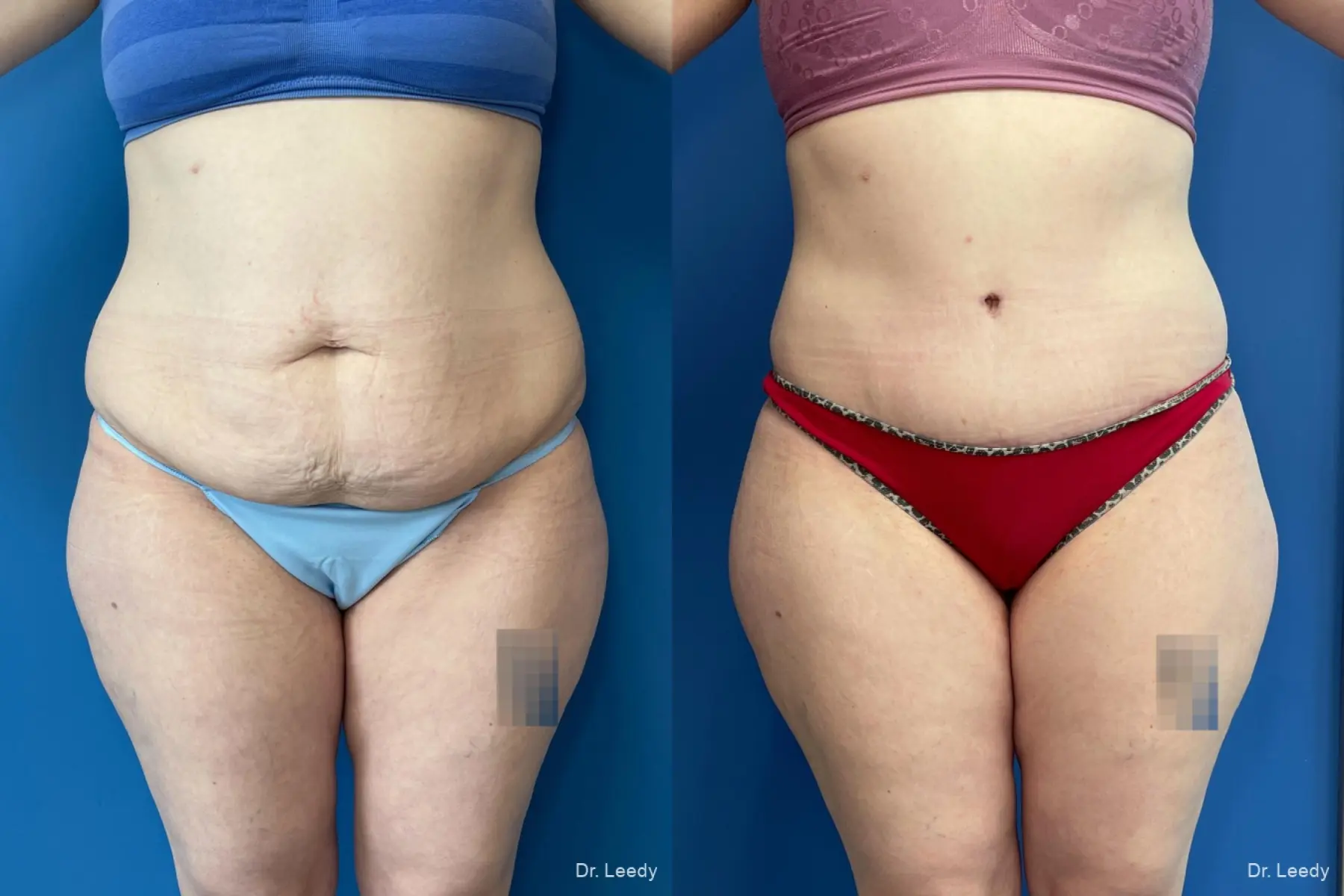 Abdominoplasty: Patient 17 - Before and After  