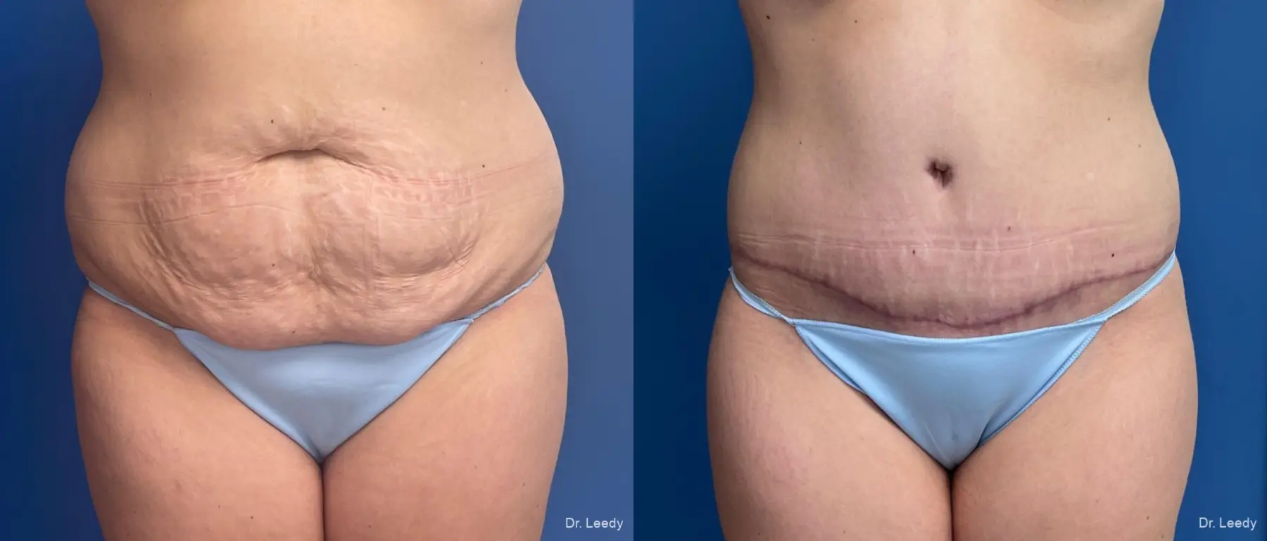 Abdominoplasty: Patient 41 - Before and After  