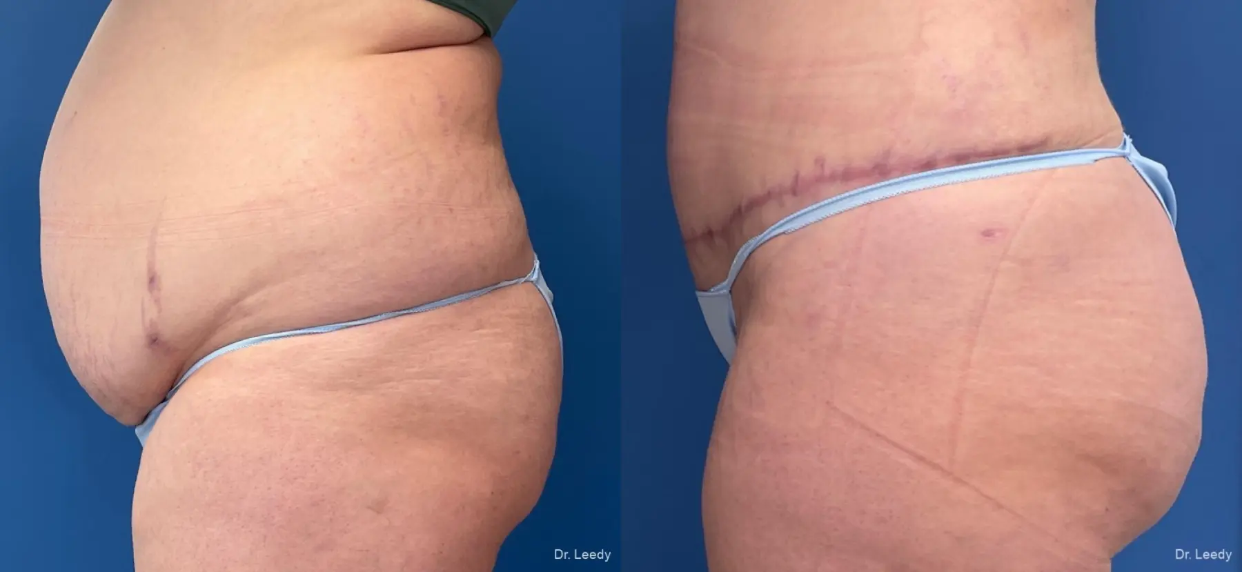 Abdominoplasty With BBL: Patient 8 - Before and After 3