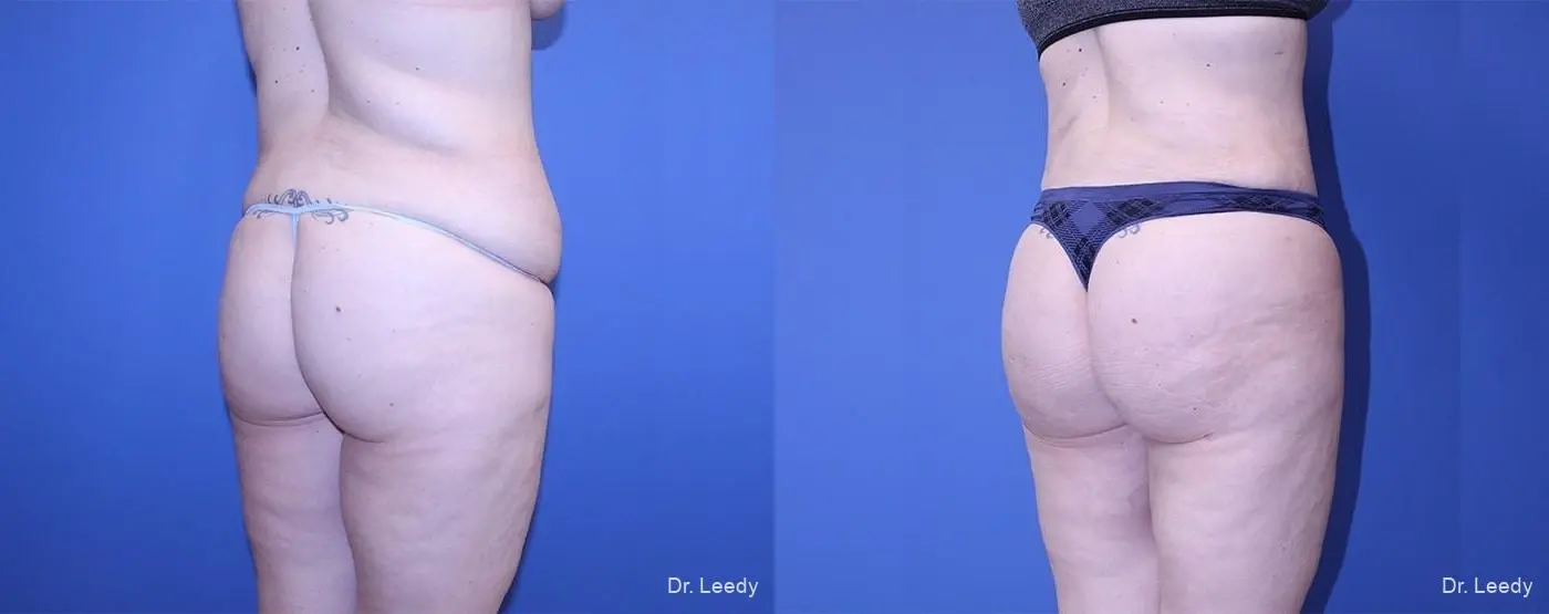Abdominoplasty With BBL: Patient 4 - Before and After  