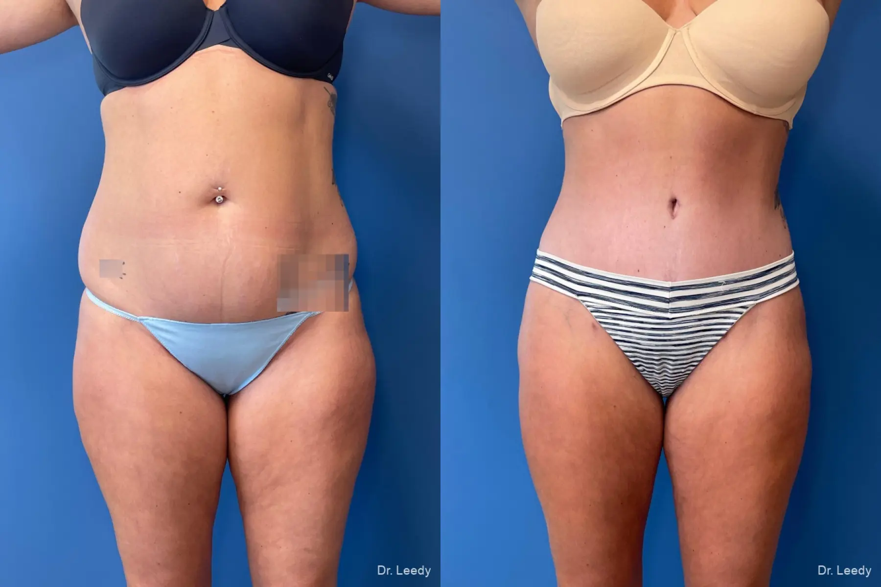 Abdominoplasty With BBL: Patient 2 - Before and After  
