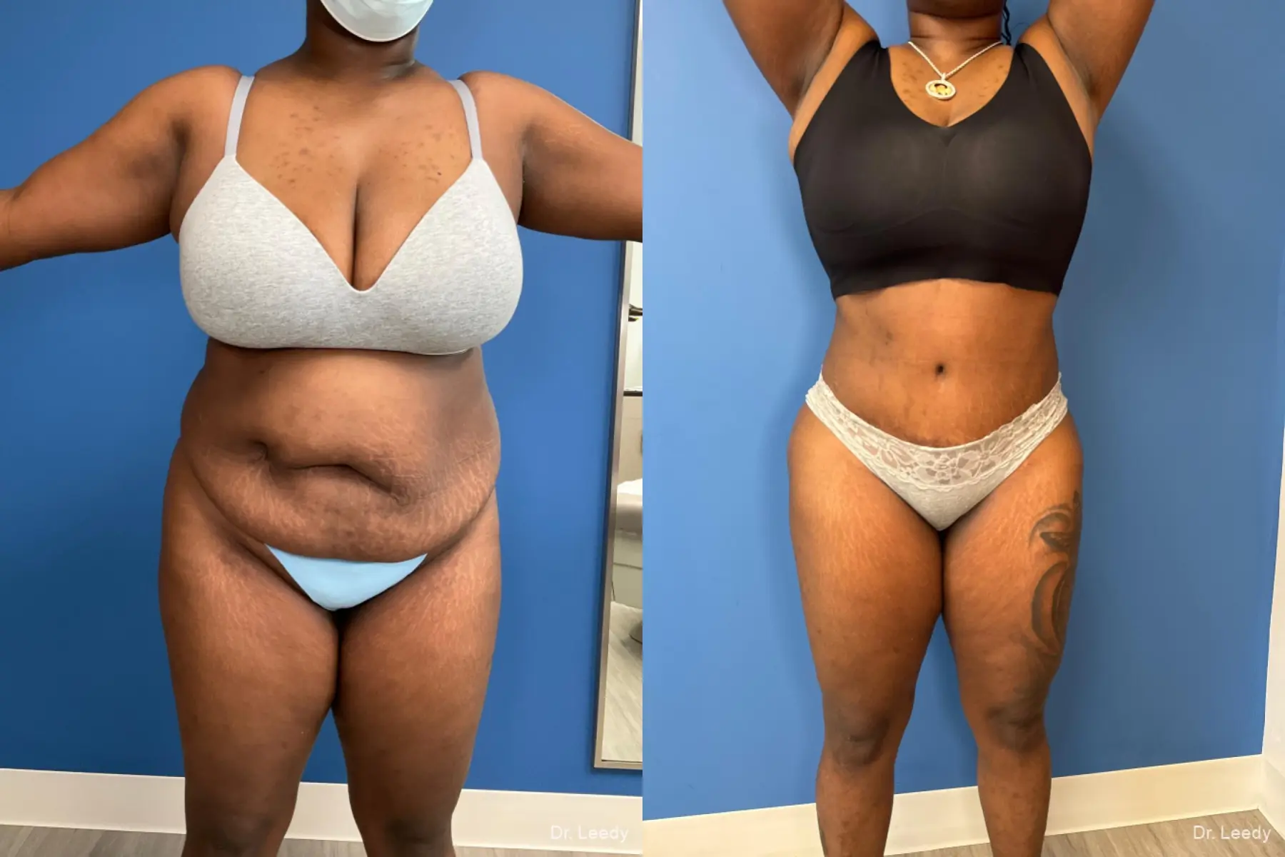 Abdominoplasty With BBL: Patient 16 - Before and After  