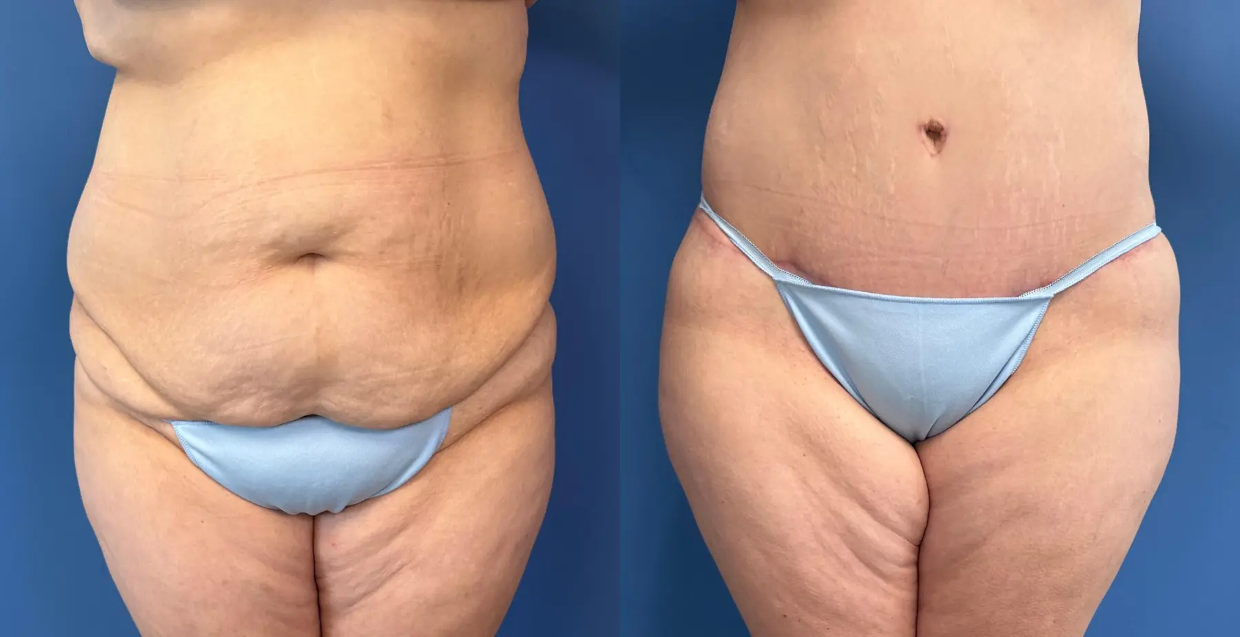 Abdominoplasty With BBL: Patient 12 - Before and After  
