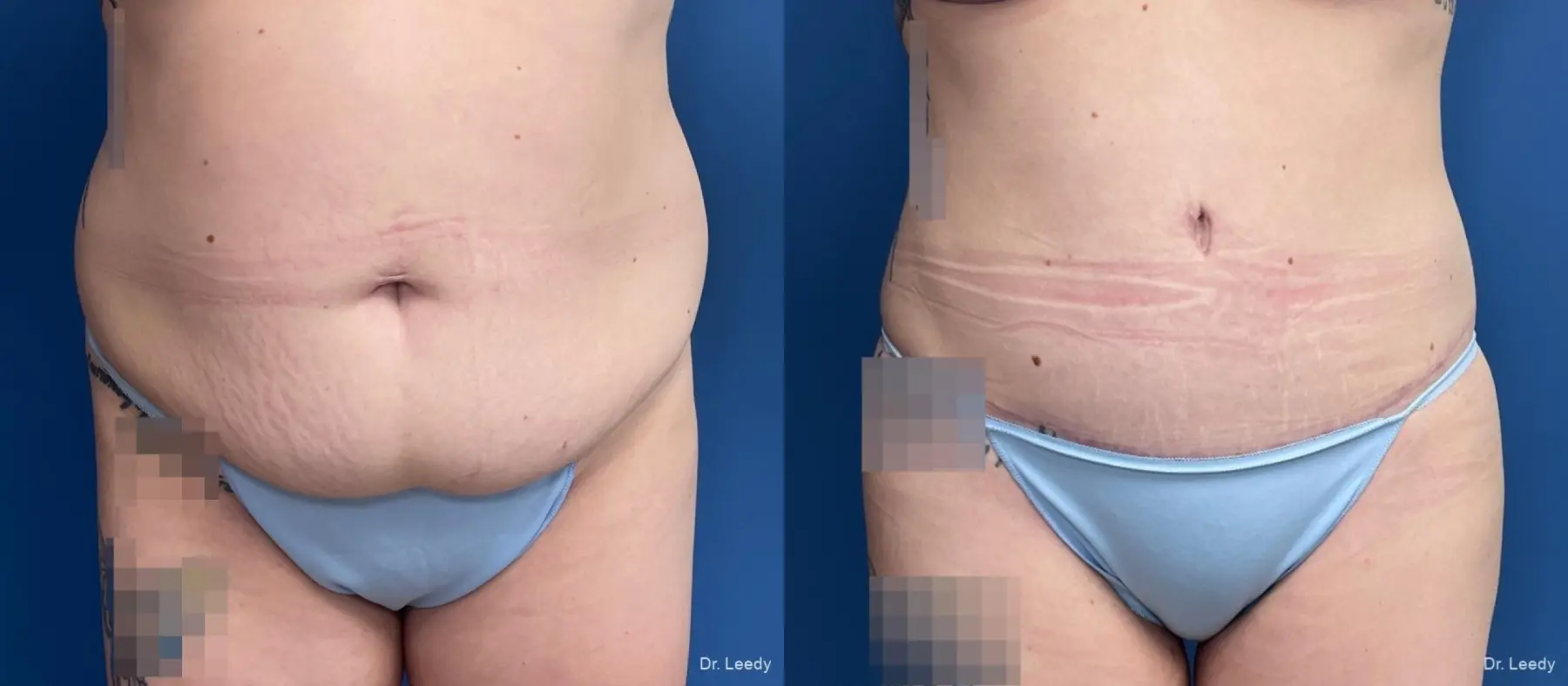 Abdominoplasty With BBL: Patient 9 - Before and After  