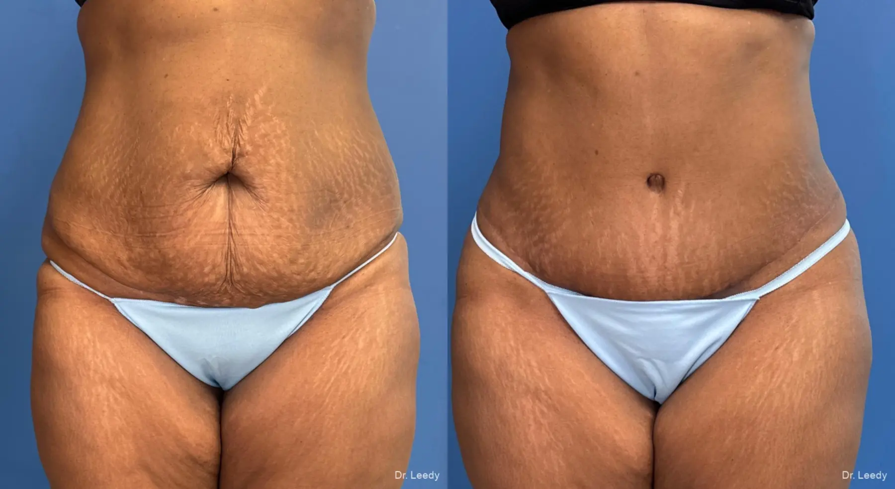 Abdominoplasty With BBL: Patient 13 - Before and After  