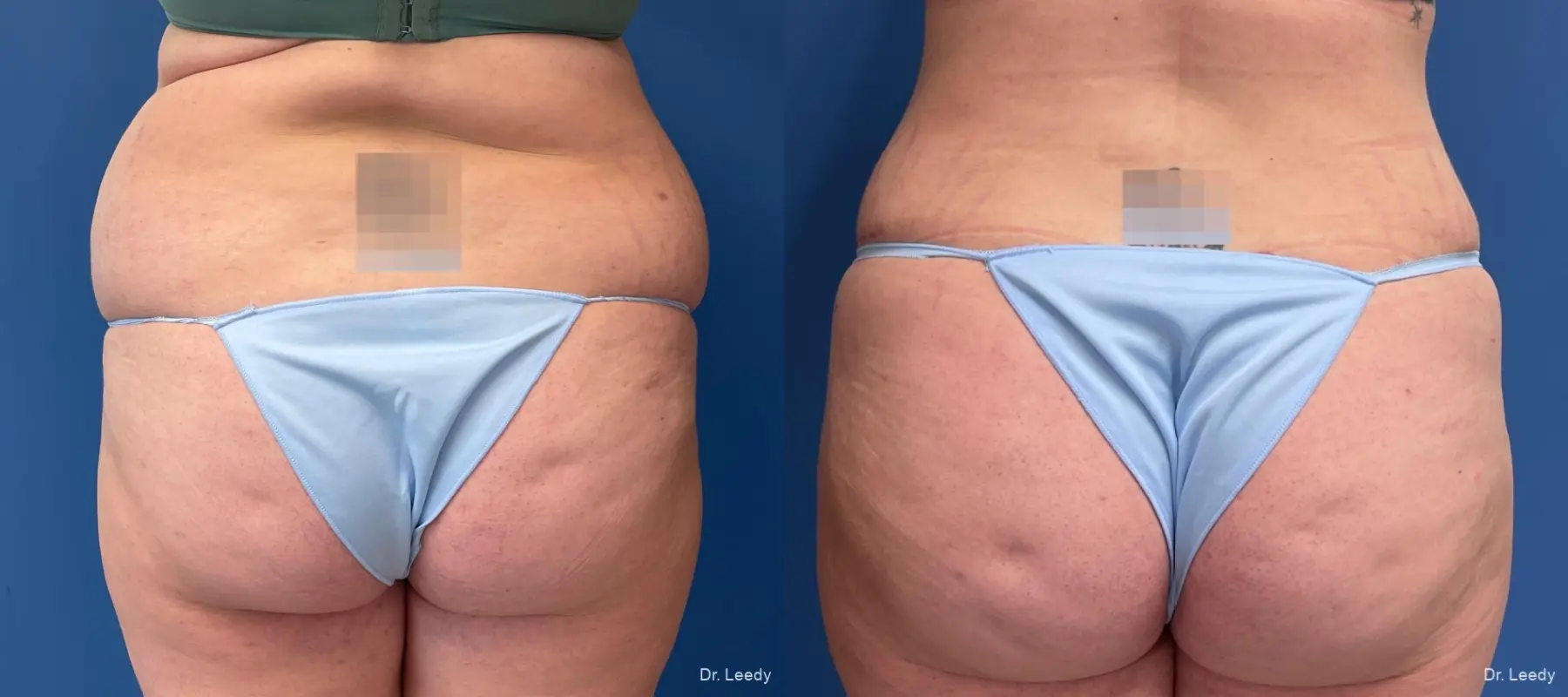 Abdominoplasty With BBL: Patient 8 - Before and After 4