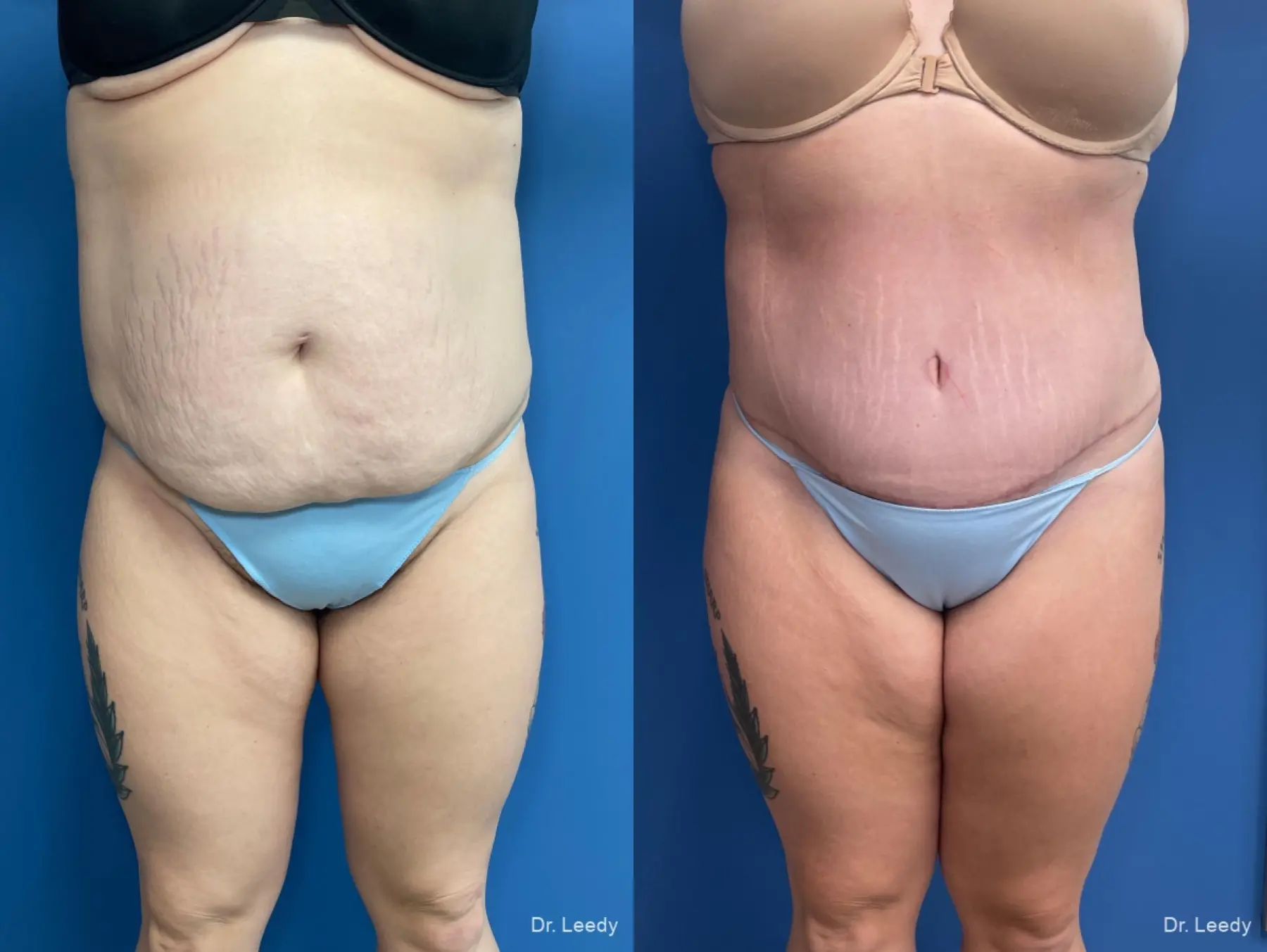 Abdominoplasty With BBL: Patient 5 - Before and After  