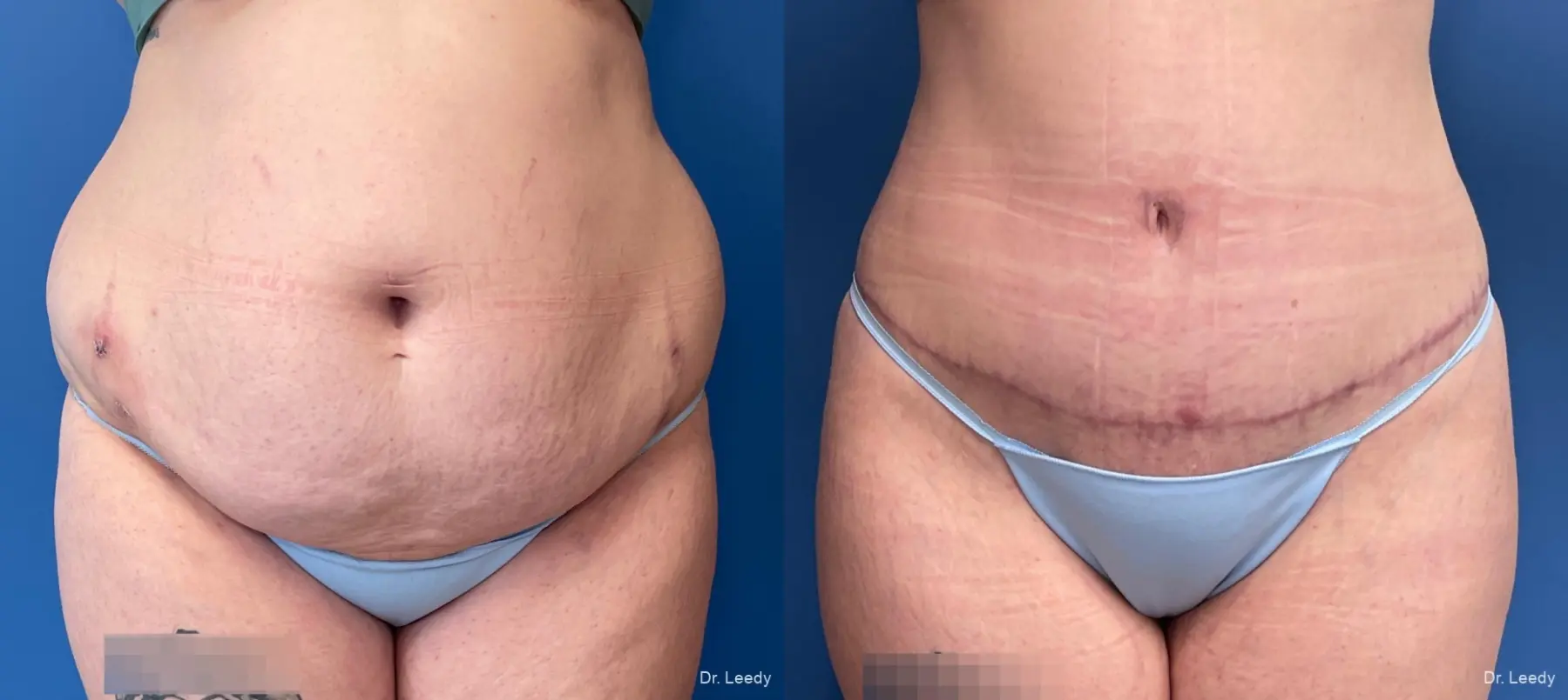 Abdominoplasty With BBL: Patient 8 - Before and After 1