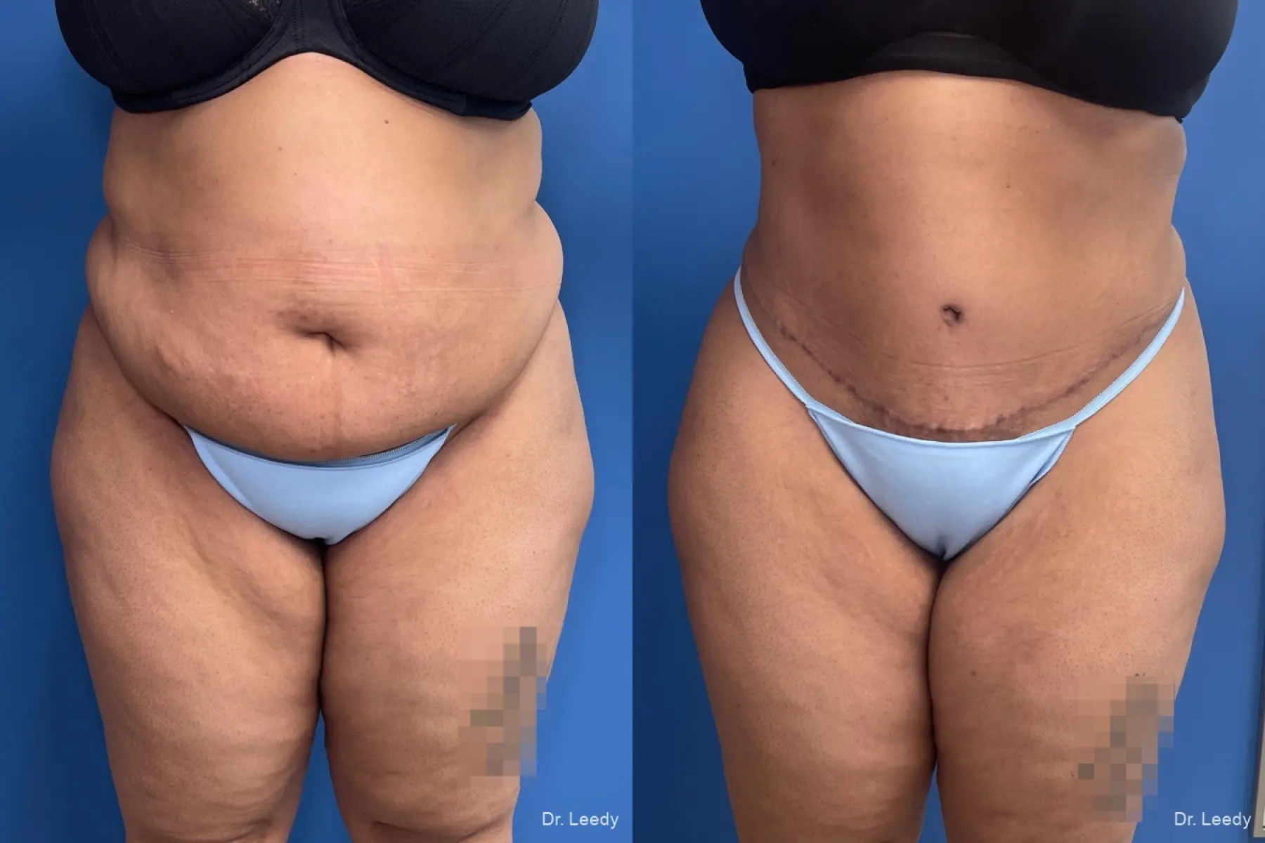 Abdominoplasty With BBL: Patient 6 - Before and After  