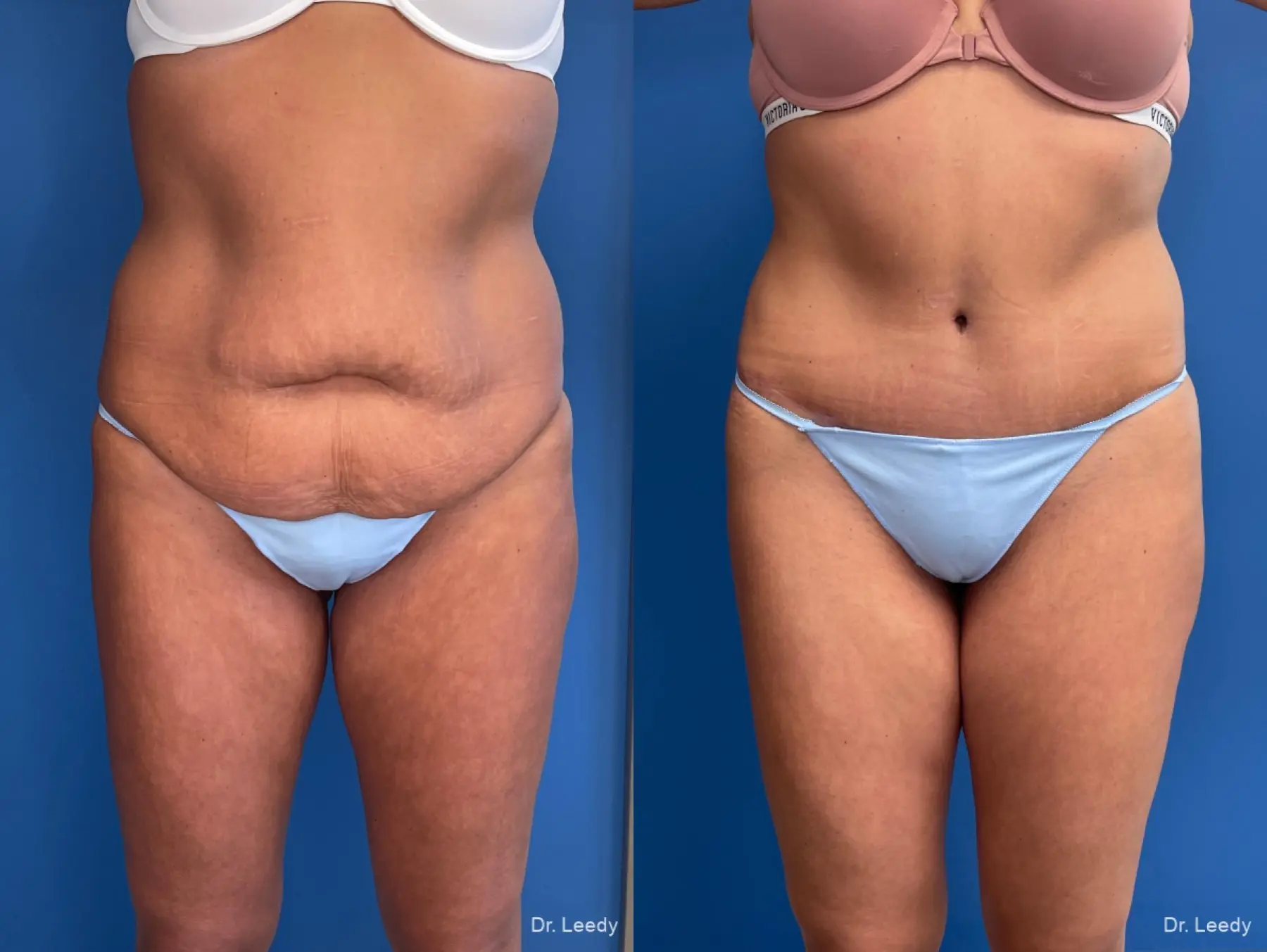 Abdominoplasty With BBL: Patient 7 - Before and After  