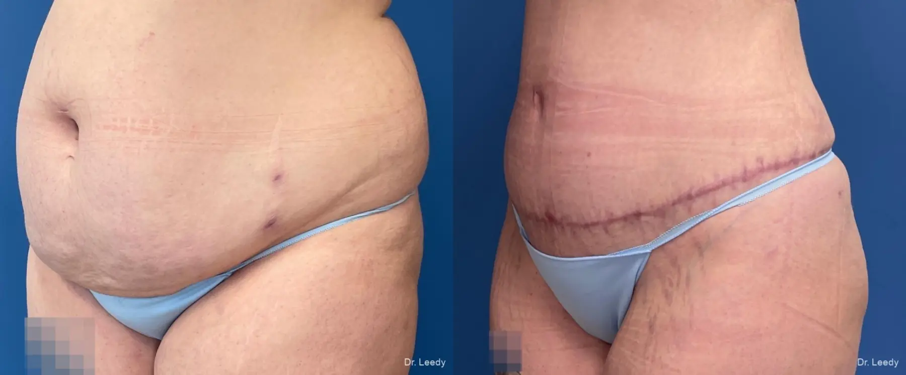 Abdominoplasty With BBL: Patient 8 - Before and After 2