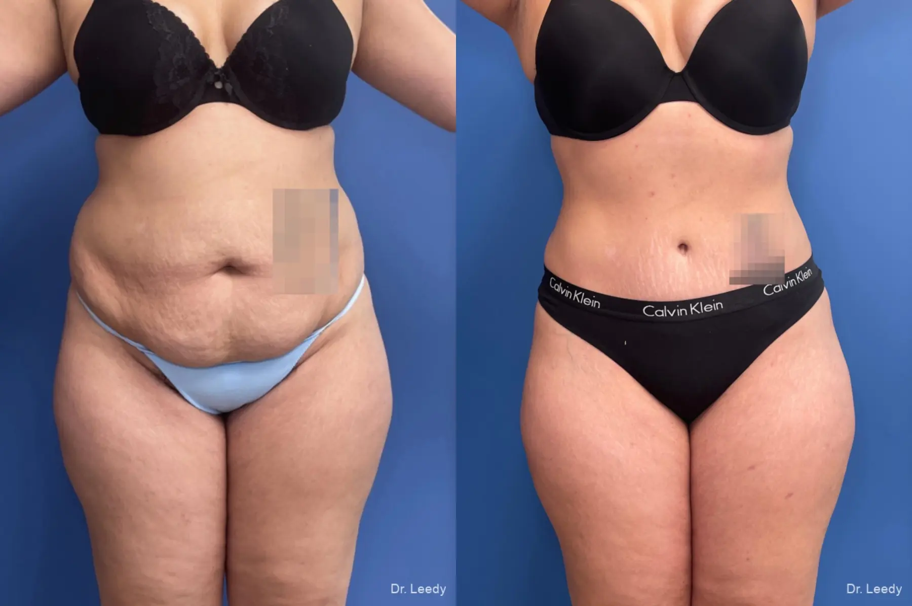Abdominoplasty With BBL: Patient 3 - Before and After  