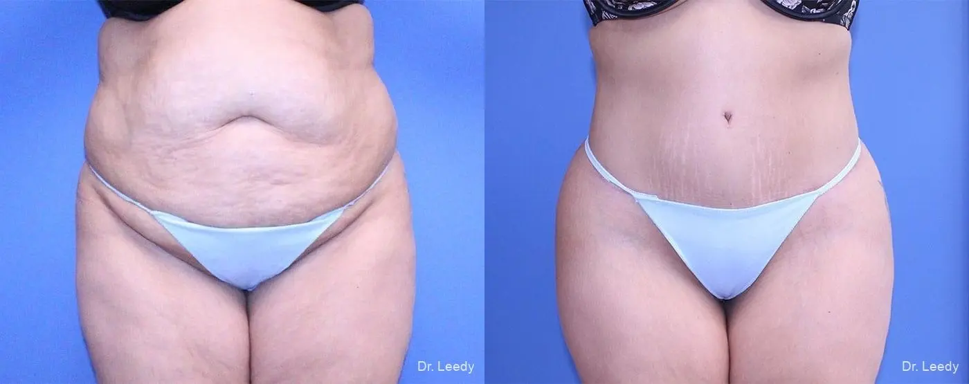 Abdominoplasty With BBL: Patient 1 - Before and After  