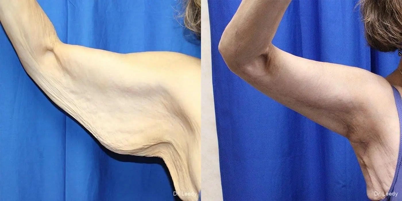 Arm Lift: Patient 3 - Before and After 2