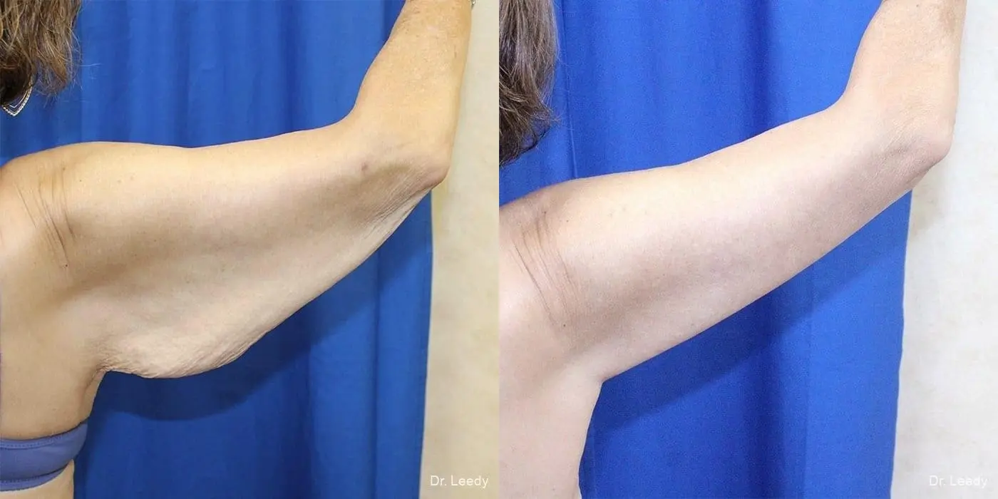 Arm Lift: Patient 1 - Before and After 3