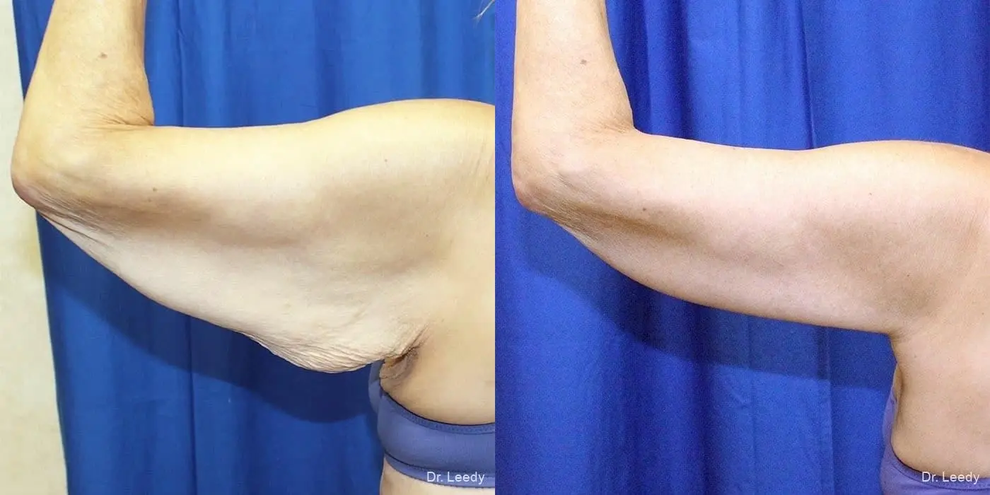 Arm Lift: Patient 1 - Before and After 4