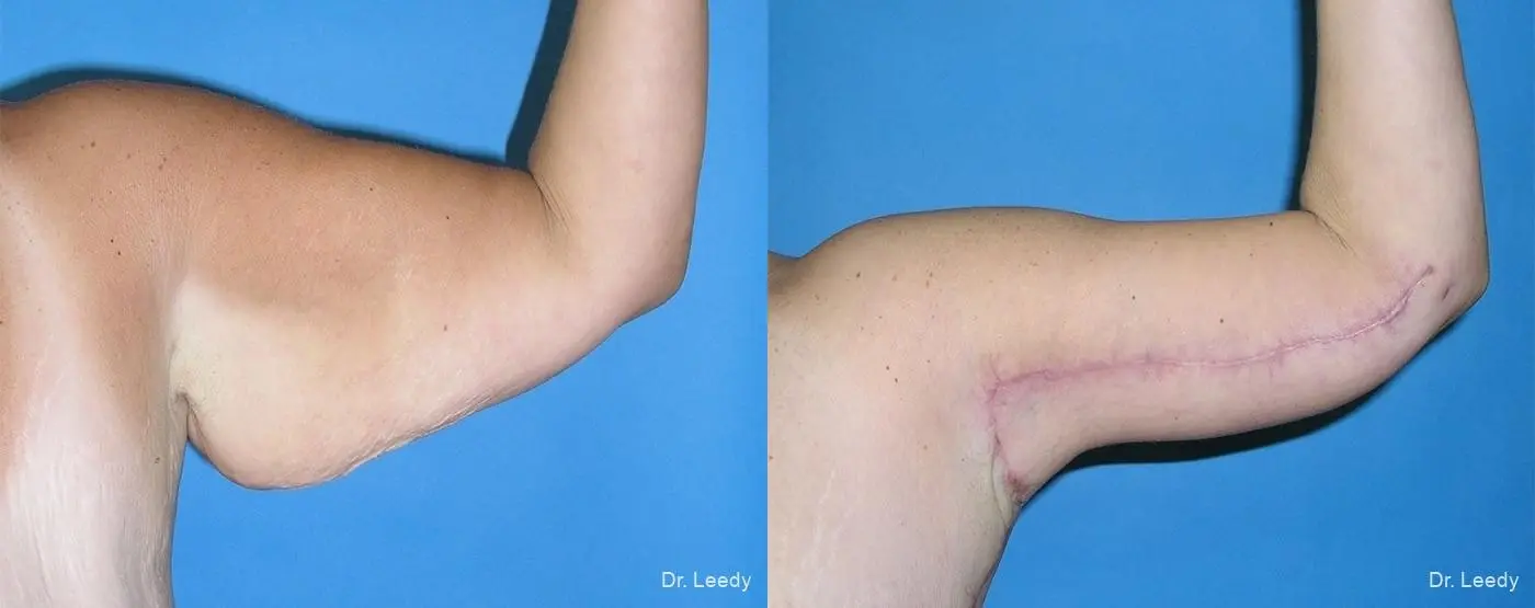 Arm Lift: Patient 1 - Before and After 2