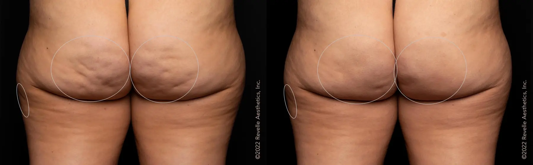 Aveli: Patient 10 - Before and After  