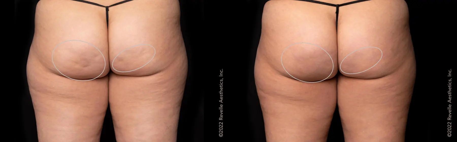 Aveli: Patient 20 - Before and After  