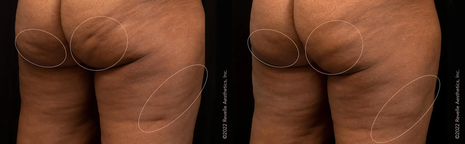 Aveli: Patient 5 - Before and After  