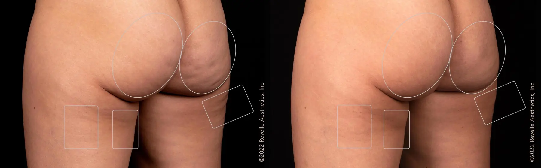 Aveli: Patient 8 - Before and After  