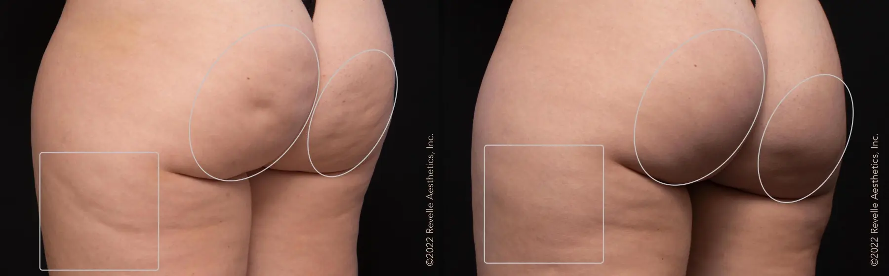Aveli: Patient 4 - Before and After  